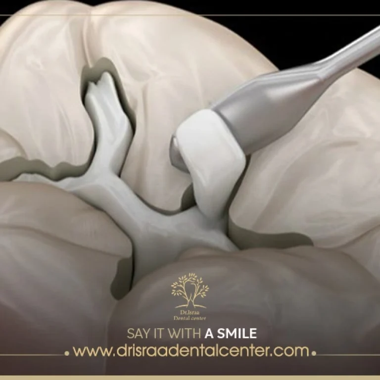 حشو الأسنان الأبيض