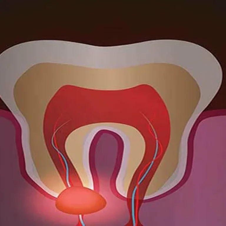 خراج الضرس الداخلي