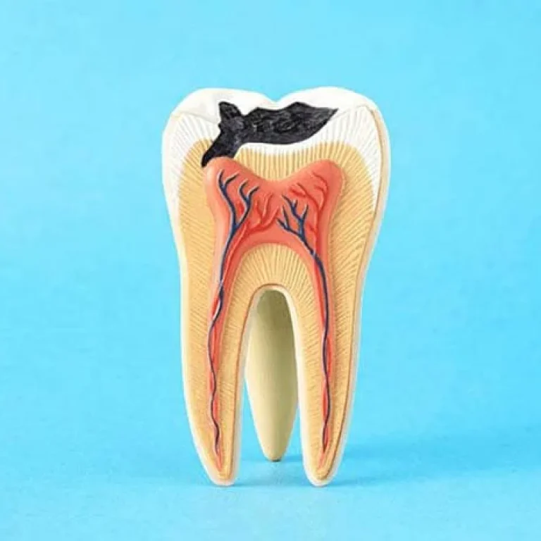 خراج الضرس بعد سحب العصب