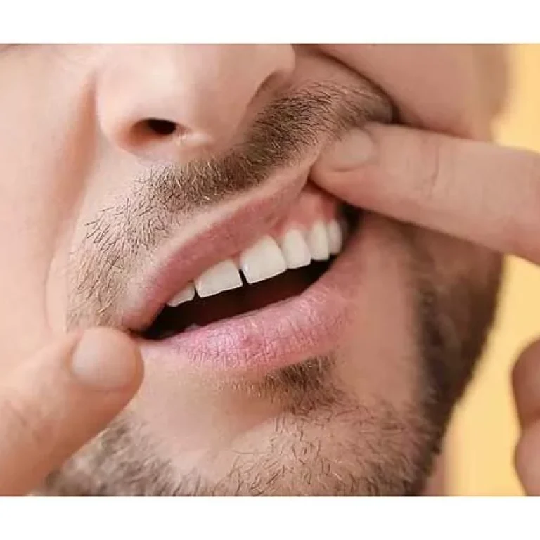 خراج اللثة السفلية