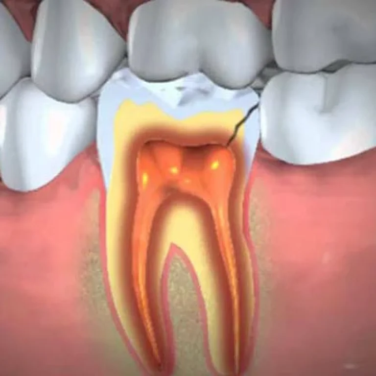 خراج تحت الضرس