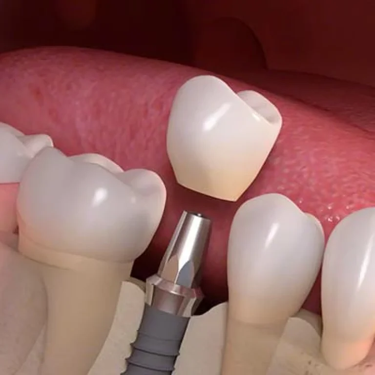 خطوات زراعة الاسنان