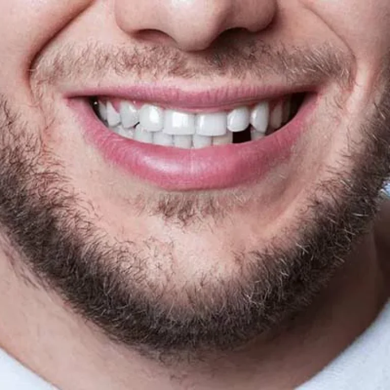 زراعة الاسنان الامامية