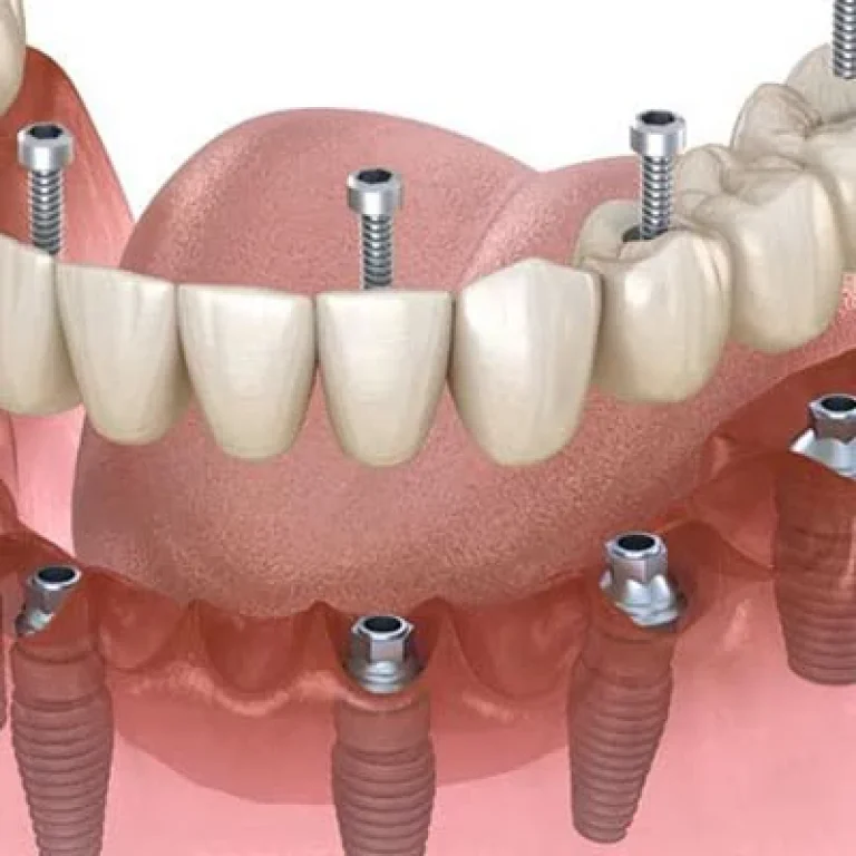 زراعة الأسنان الفورية