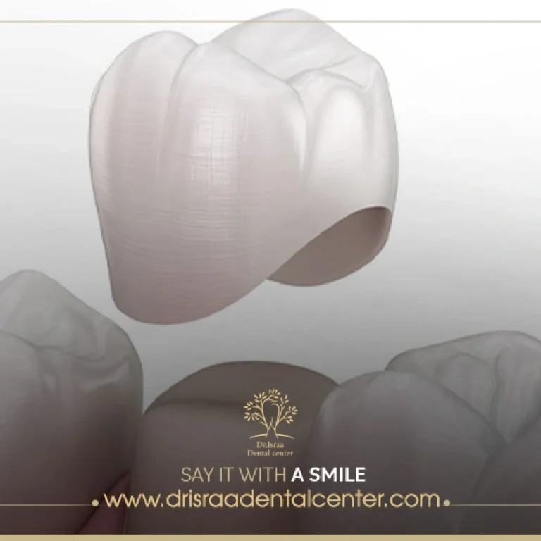 سعر تلبيس الاسنان