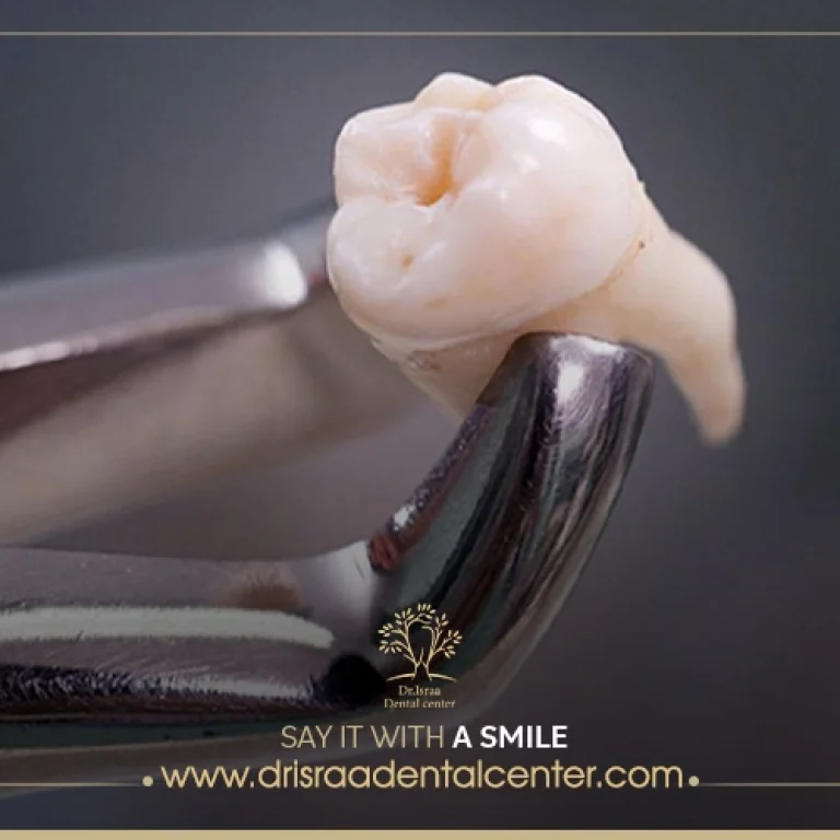 سعر خلع ضرس العقل