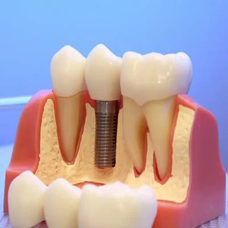 شكل طربوش الأسنان