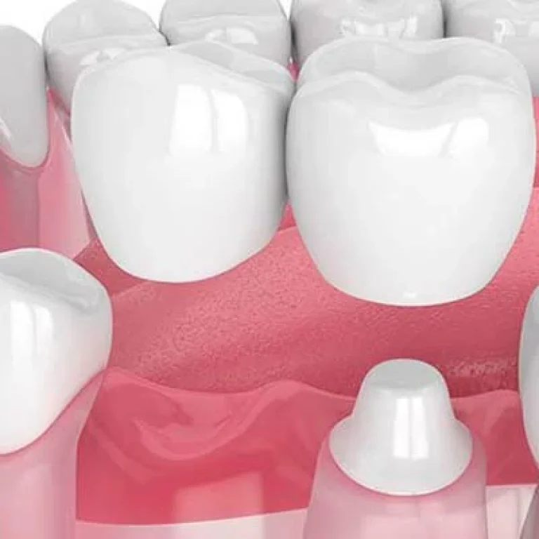 طربوش الاسنان