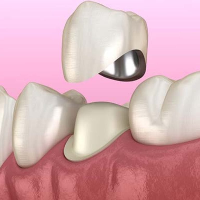 طربوش الأسنان الأمامية