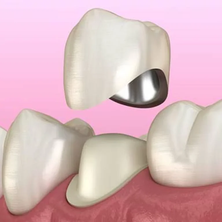 طربوش الاسنان الزيركون