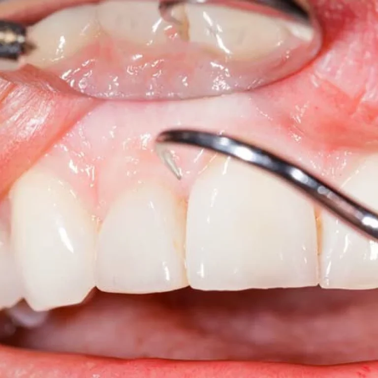 علاج التهاب اللثة تحت التلبيسة