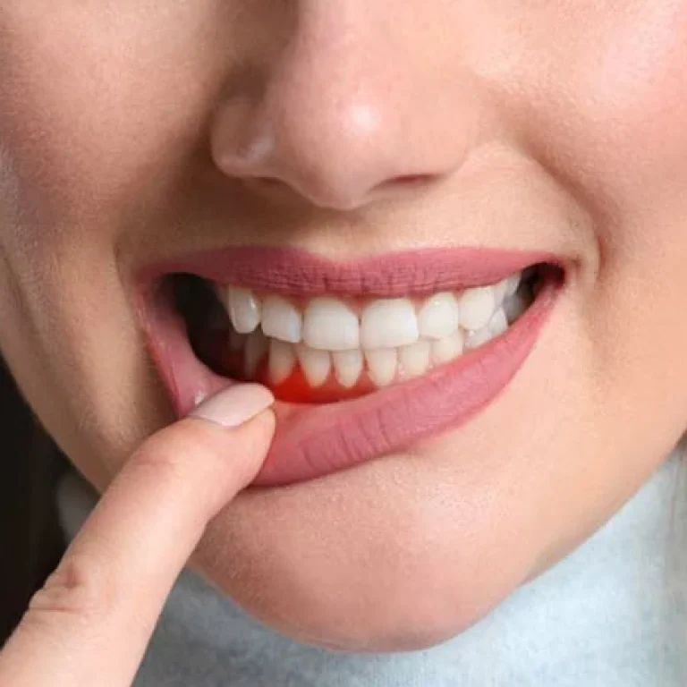 علاج خراج اللثة