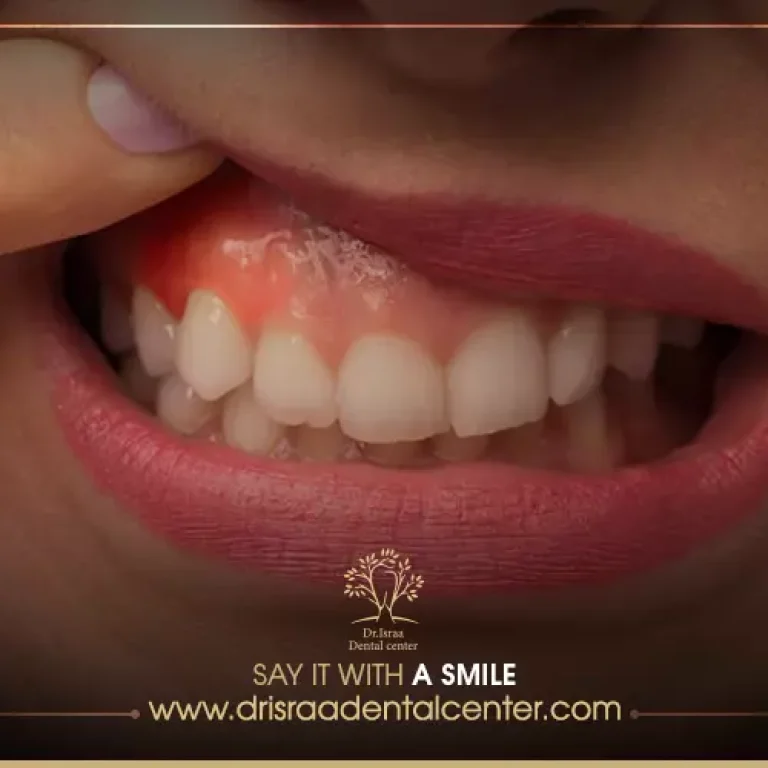علاج نزول اللثة وتعري الأسنان