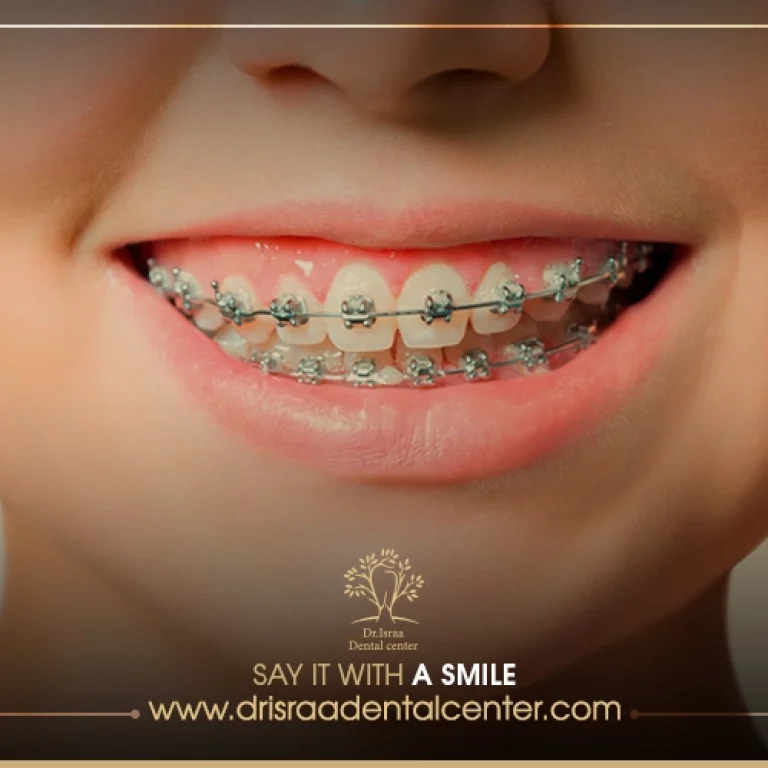 فوائد تقويم الاسنان