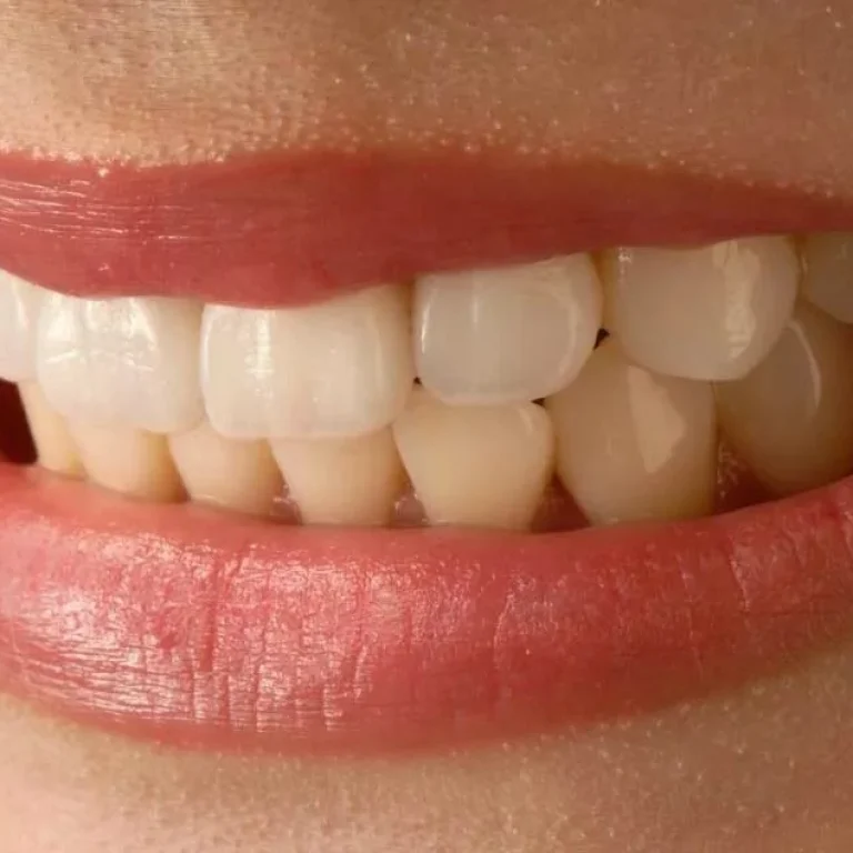 فينير الاسنان