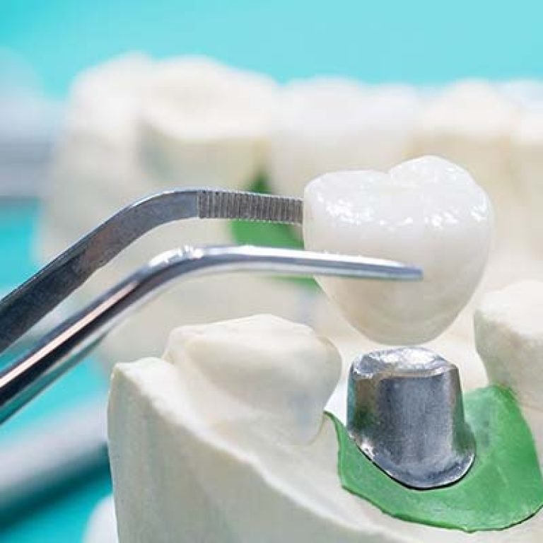 مشاكل طربوش الأسنان