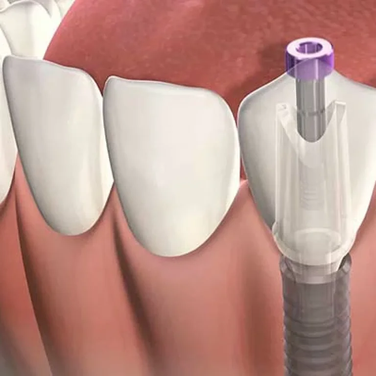 هل زراعة الاسنان عملية مؤلمة