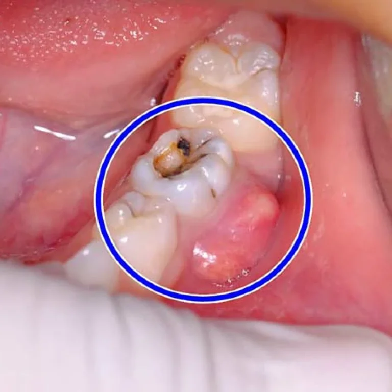 هل يمكن خلع الضرس مع وجود خراج
