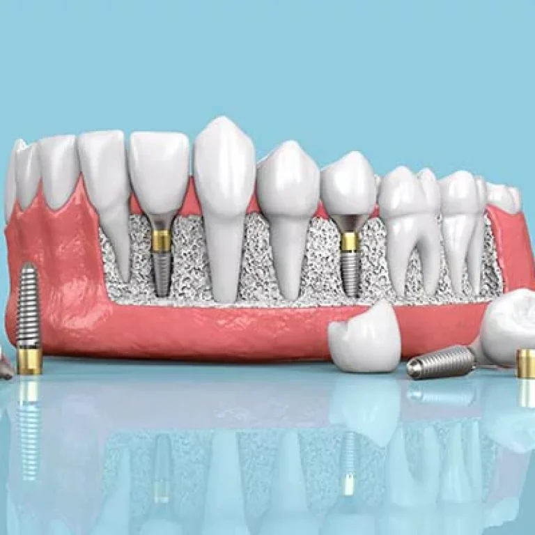زراعة الاسنان لمرضى السكر